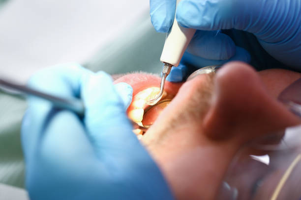 Best Emergency Root Canal Treatment in Oakville, CT